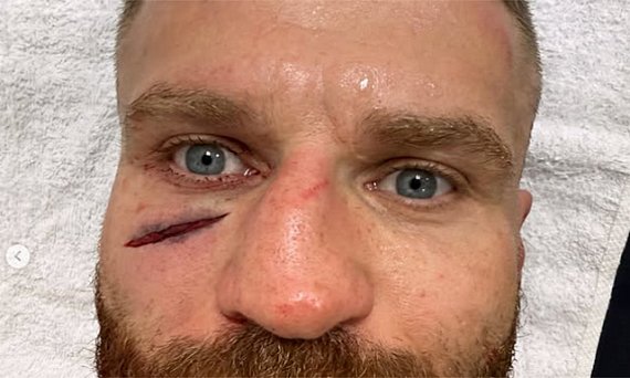 Jan Blachowicz exhibe une coupure monstrueuse après sa défaite à l’UFC Belgrade