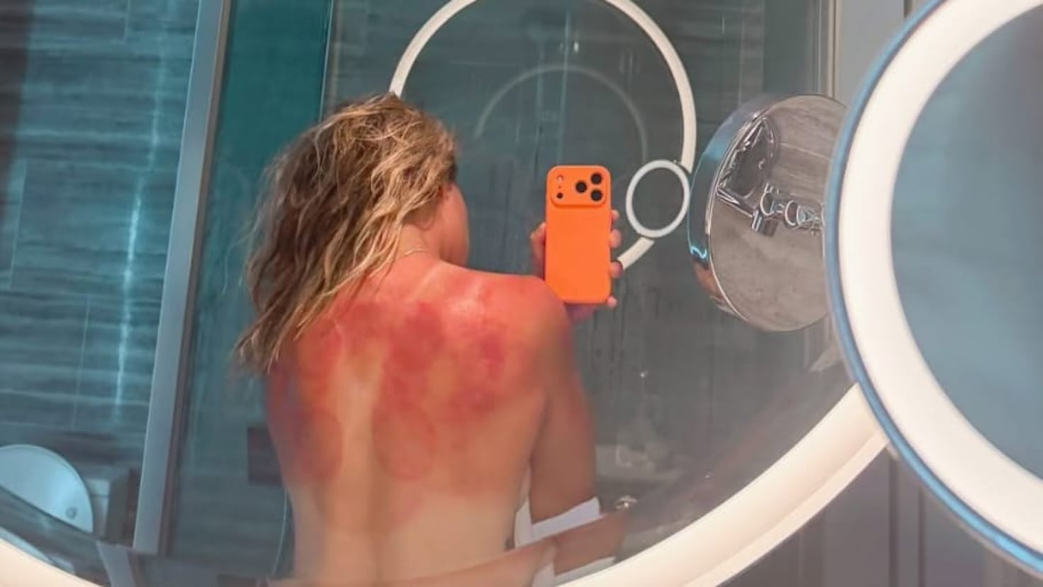 Zarazúa dévoile ses brûlures solaires d'Australie : "Ce n'est pas une plaisanterie !"