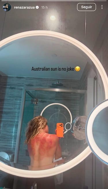 Zarazúa montre ses brûlures dues au soleil de l'Australie