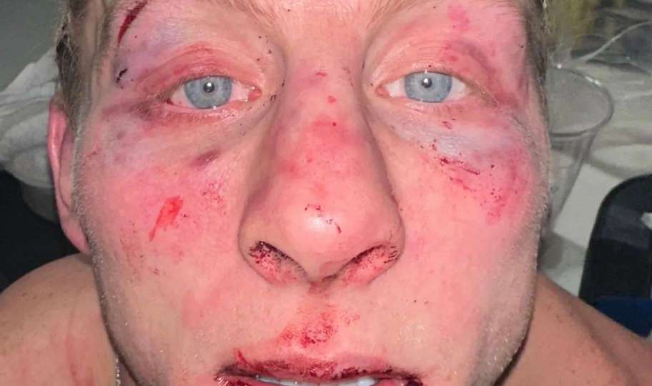 Le Meilleur du Meilleur : Retour sur la Semaine UFC/MMA – Le Visage Écorché de Paddy Piblett, Une Horrible Vision !